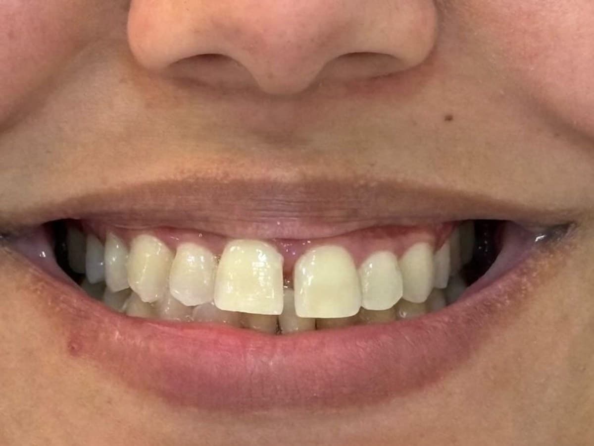 Fechamento de diastema: antes