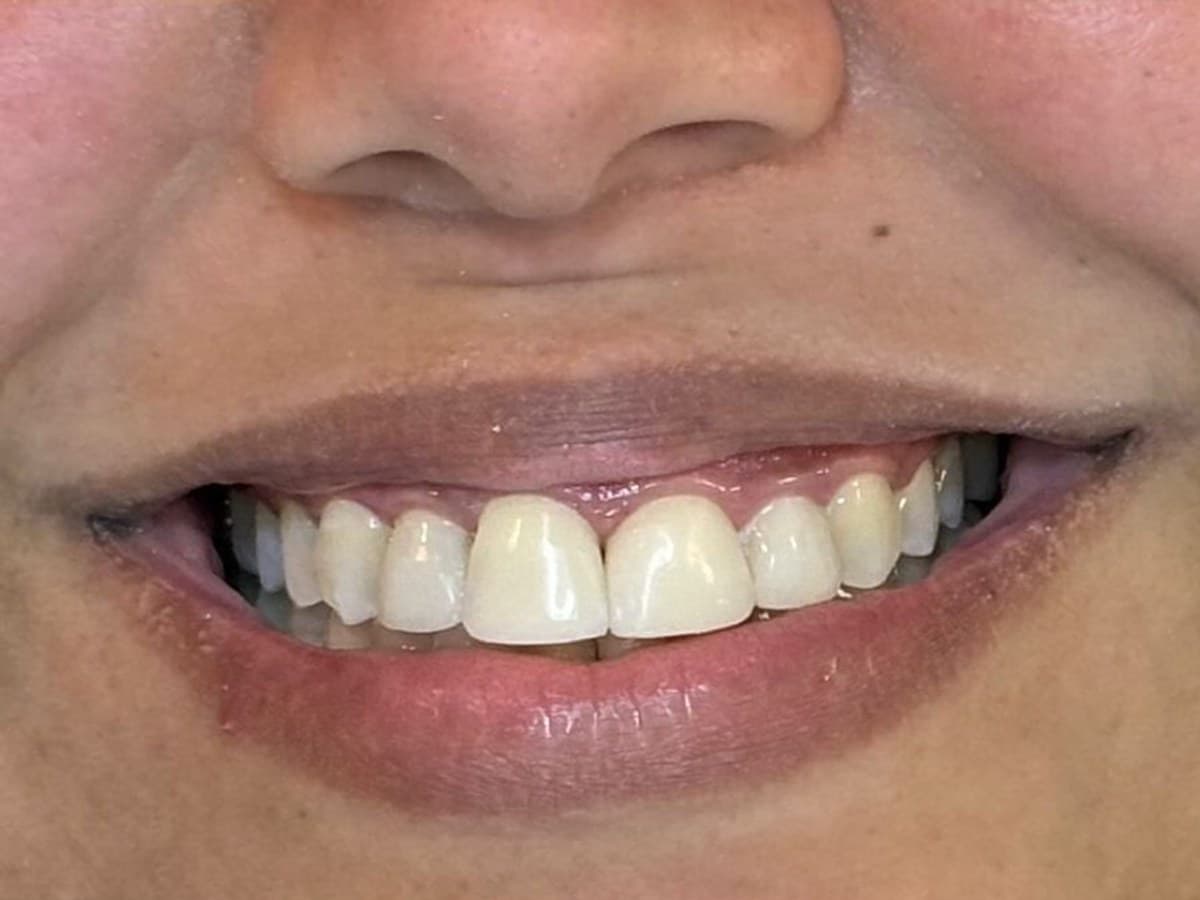 Fechamento de diastema: depois