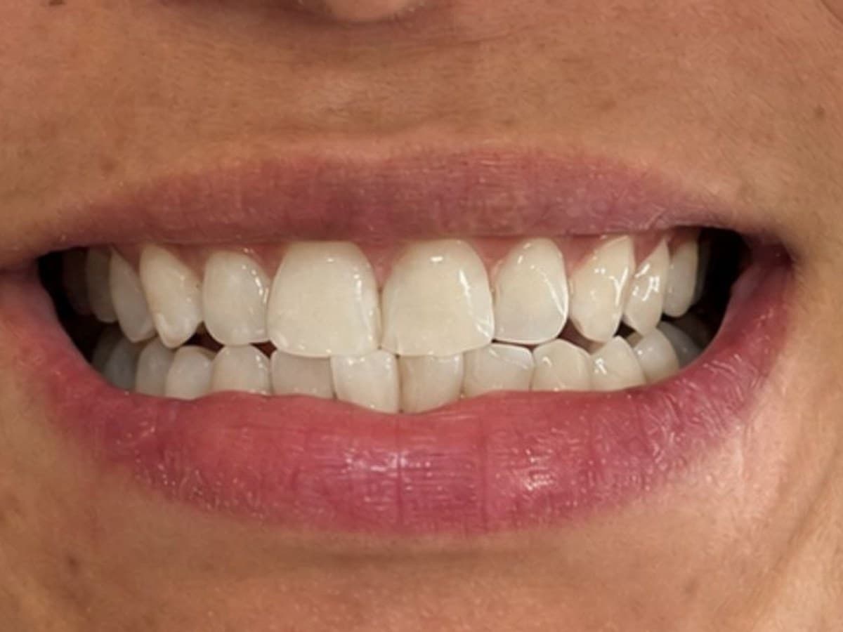 Harmonia do sorriso: depois