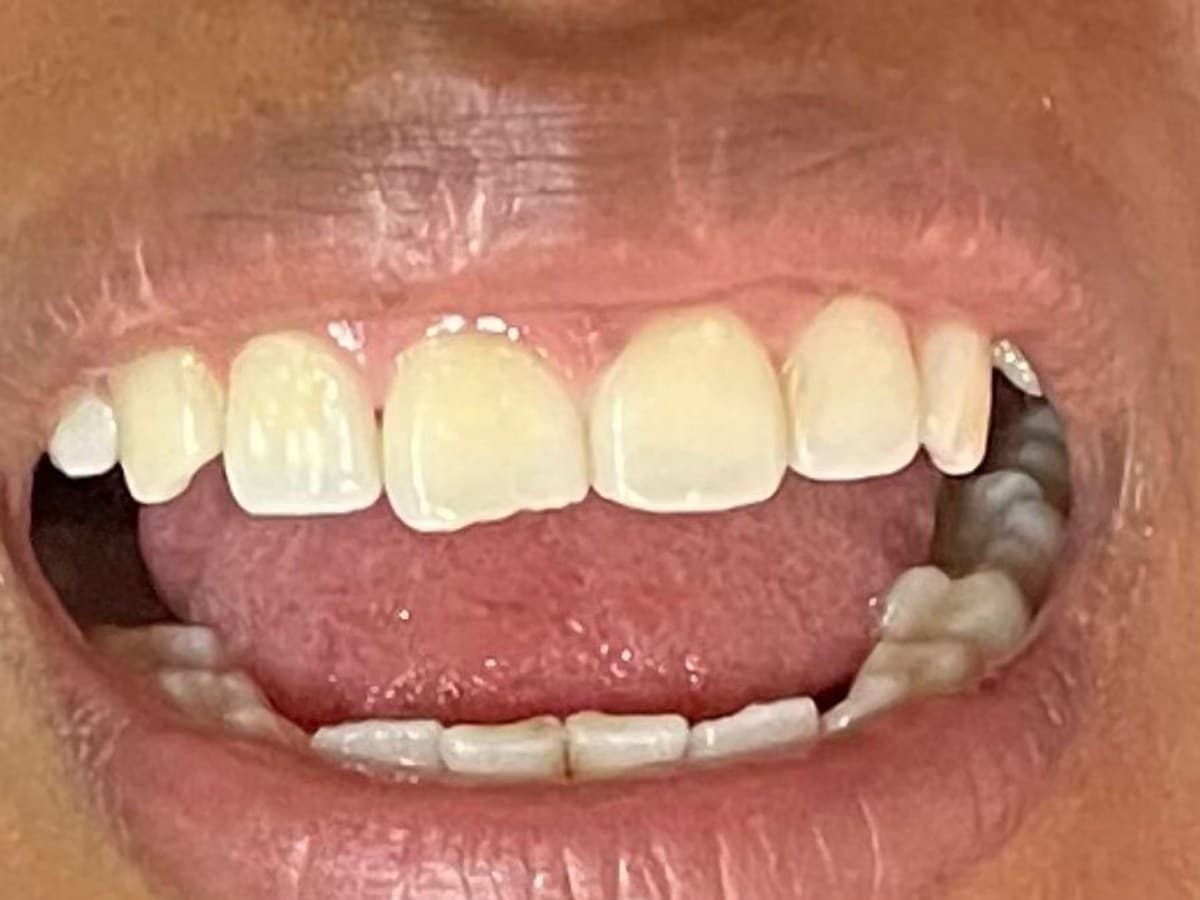 Reanatomização dental: antes